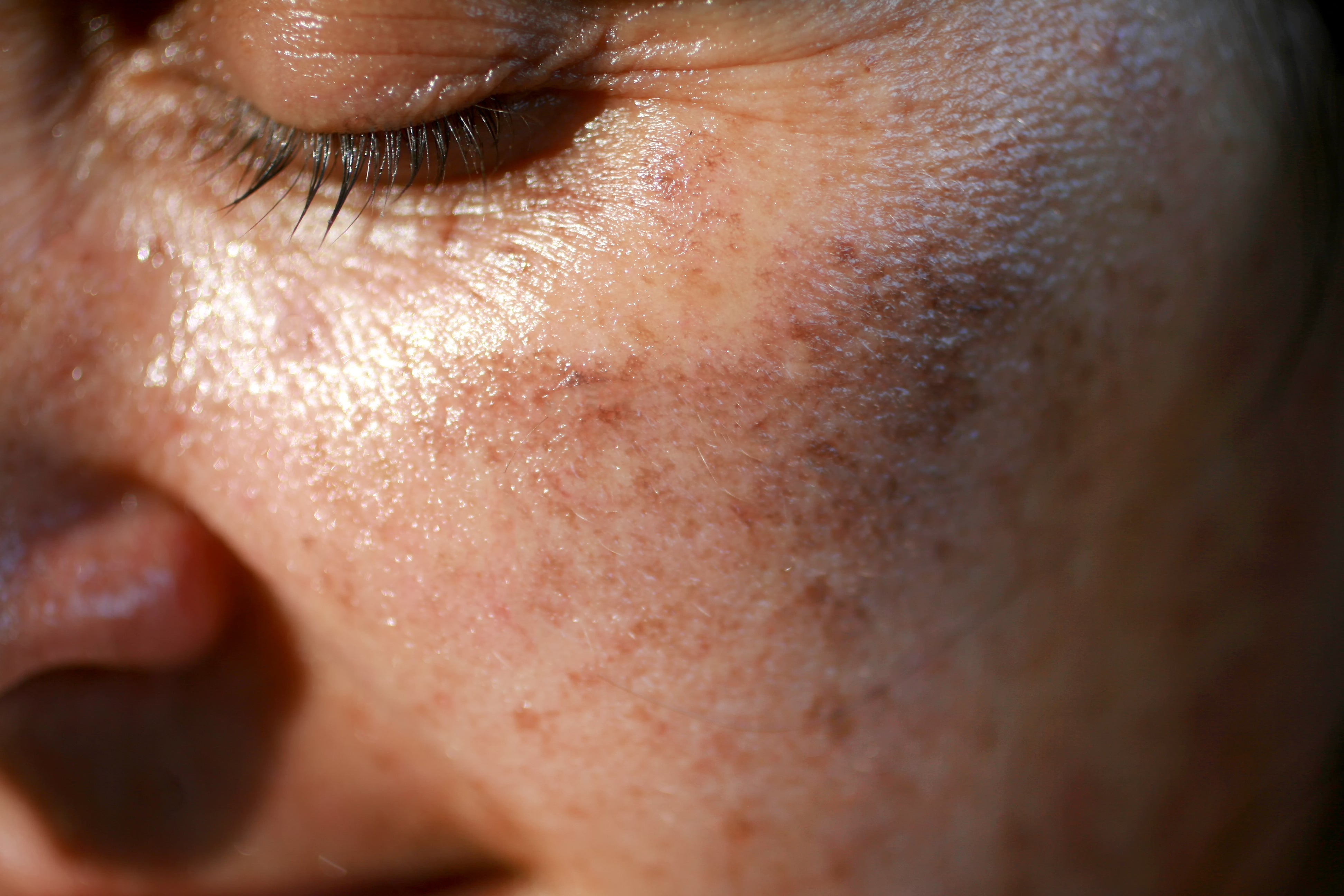 How To Treat Sun-Damaged Skin