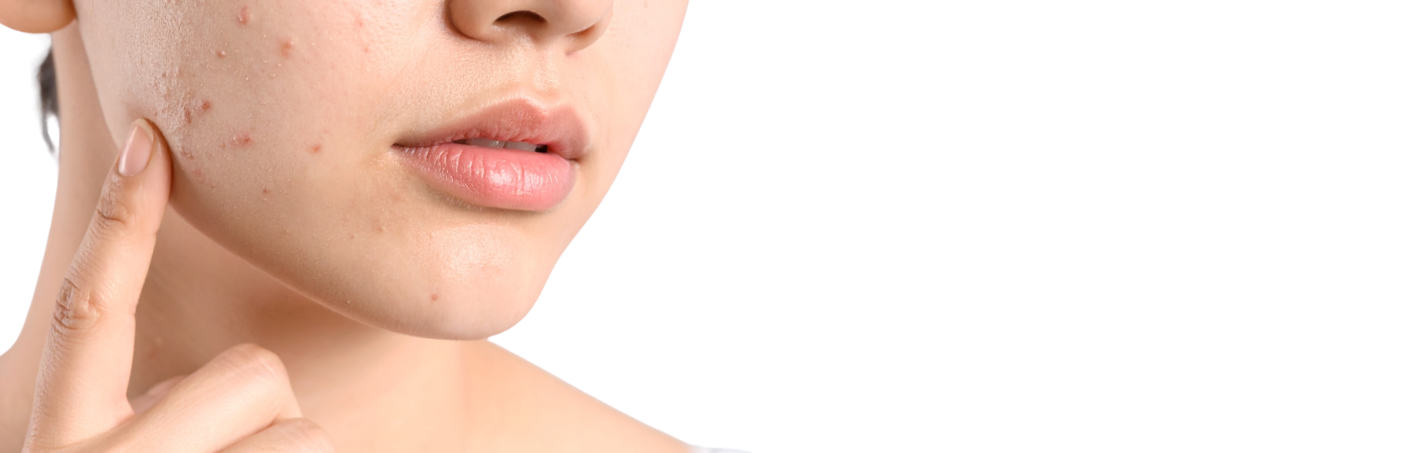 Concern: Acne & Breakouts Moisturisers