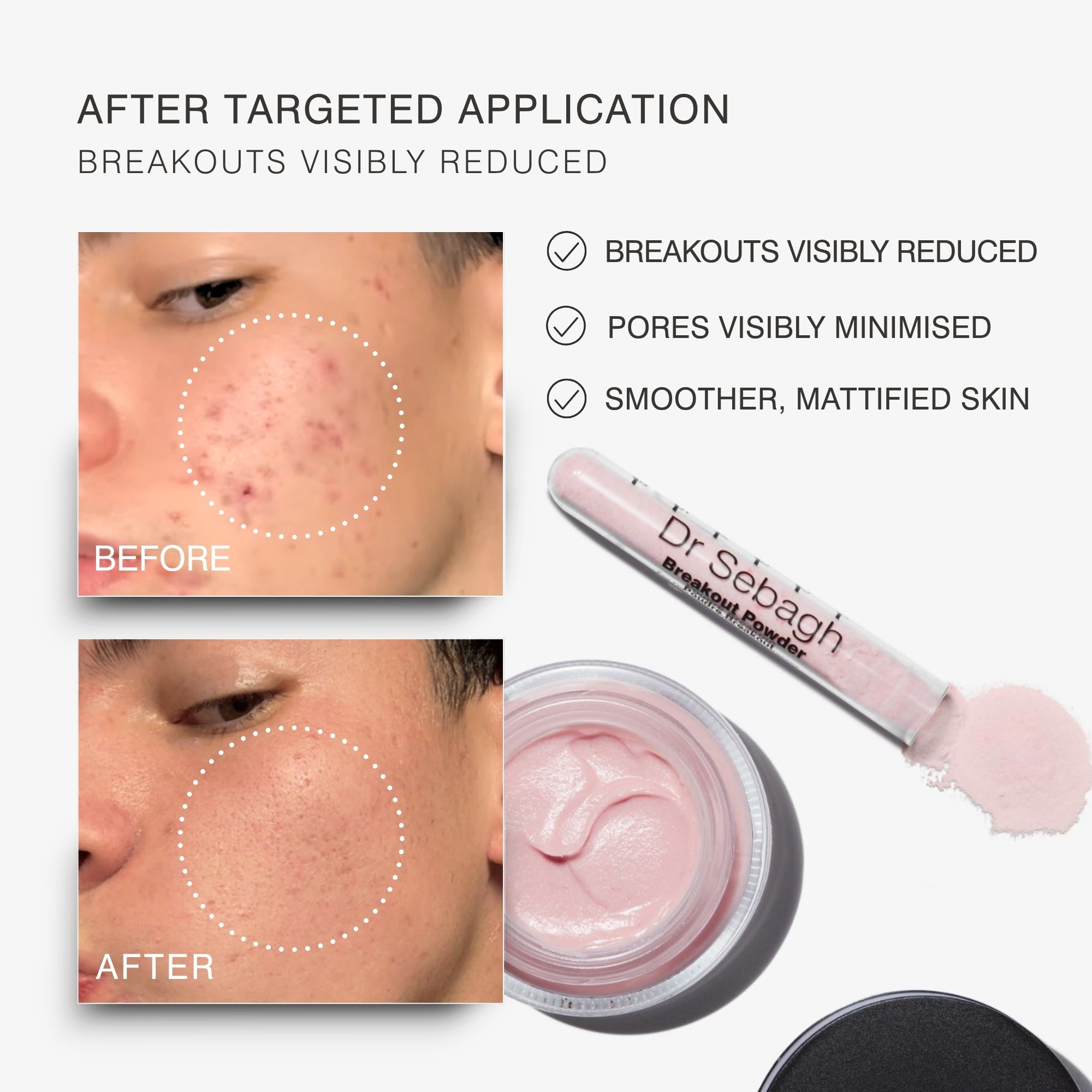 Before-and-after skin comparison showing acne reduction on a person's cheek, alongside a tube of Dr Sebagh Breakout Powder and an open jar of light pink powder on a white background.
