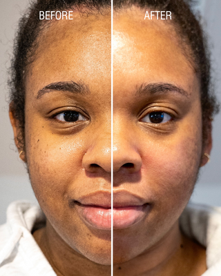 Hydrafacial