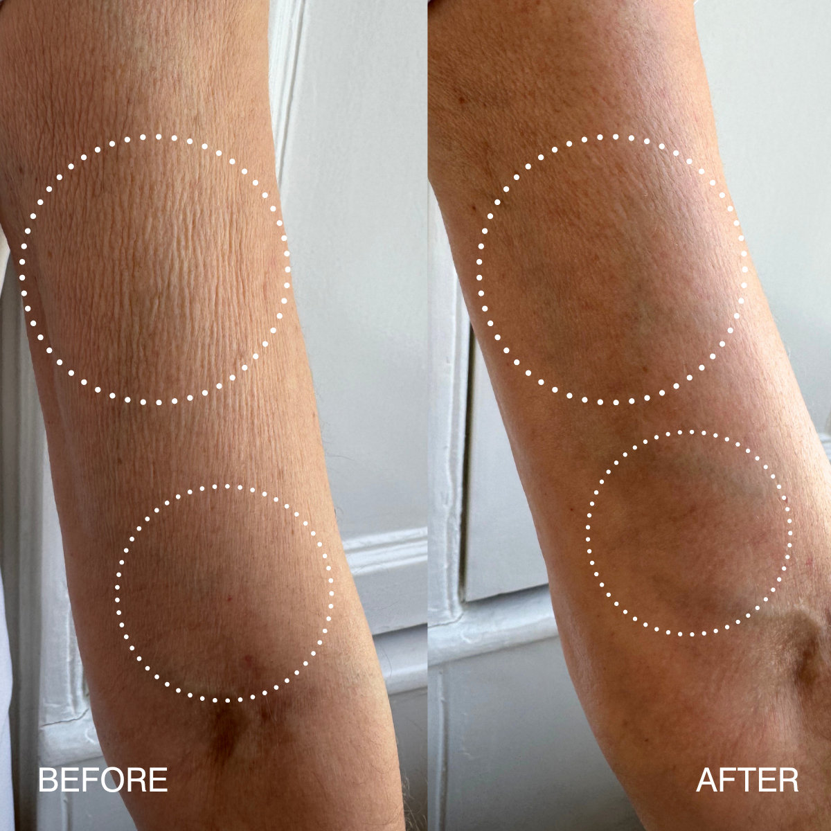 Before-and-after comparison of a person's forearm showing skin texture improvement, with dotted circles highlighting areas of concern and the text 'BEFORE' and 'AFTER' at the bottom.